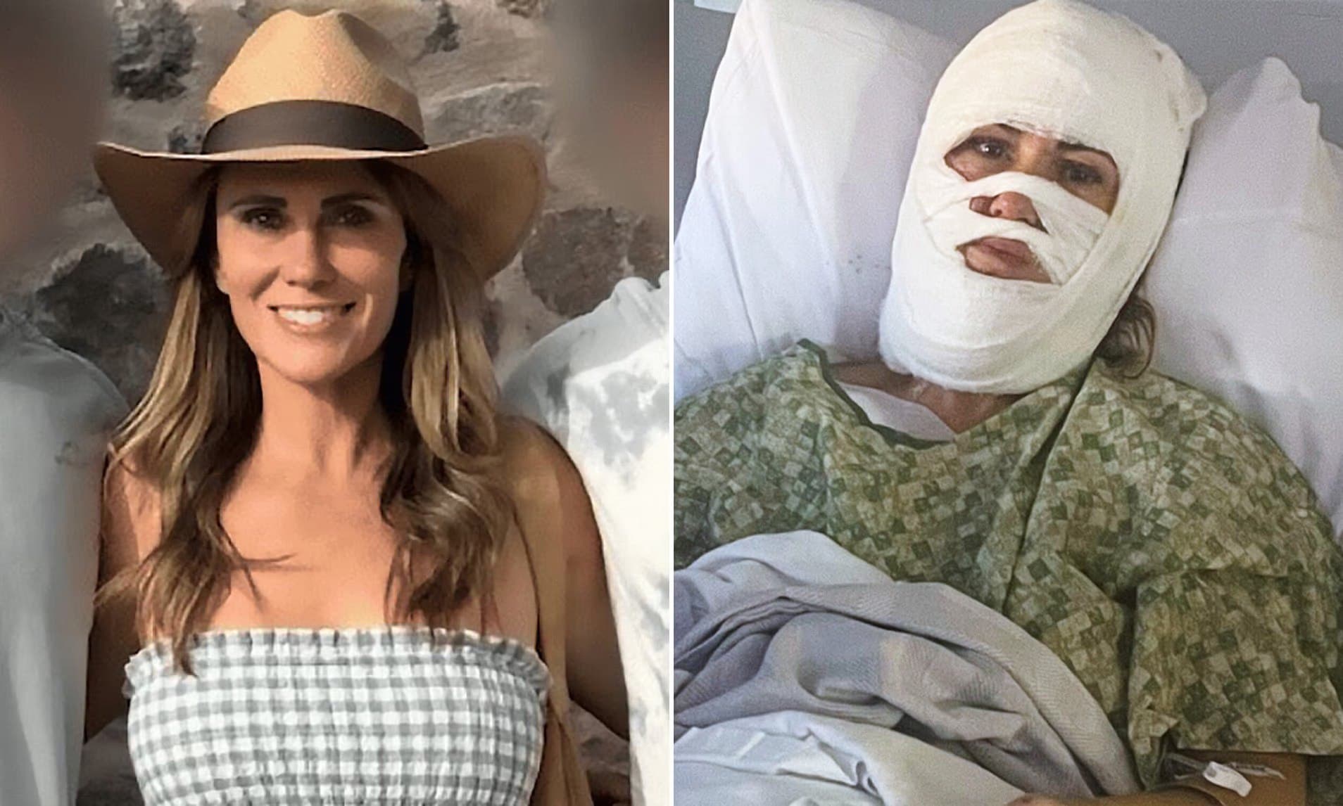 Georgia woman disfigured and facing millions in medical bills after acid attack