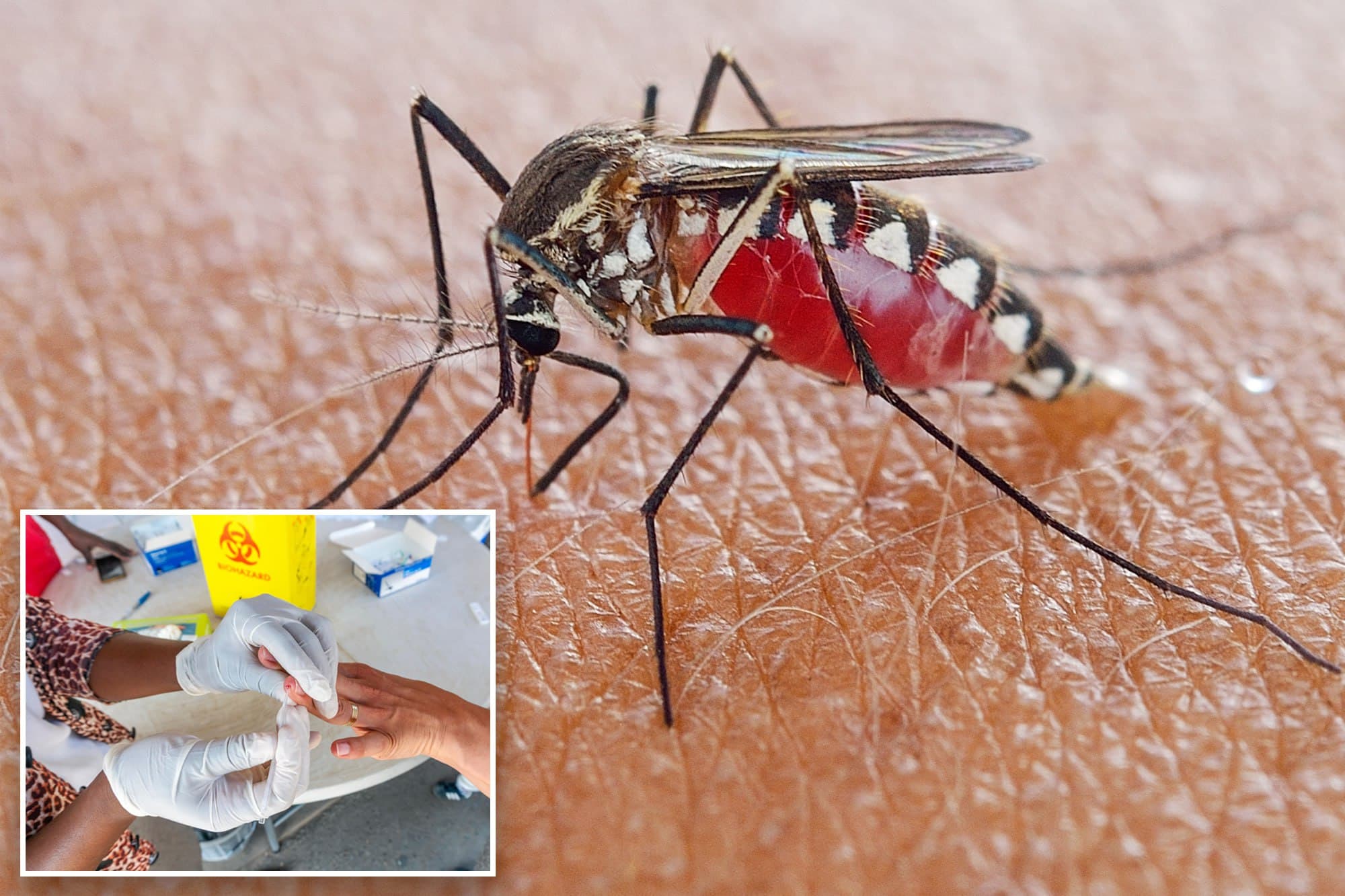 Featured image for: First Local Malaria Case in 27 Years Reported in New Jersey First Local Malaria Case in 27 Years Reported in New Jersey