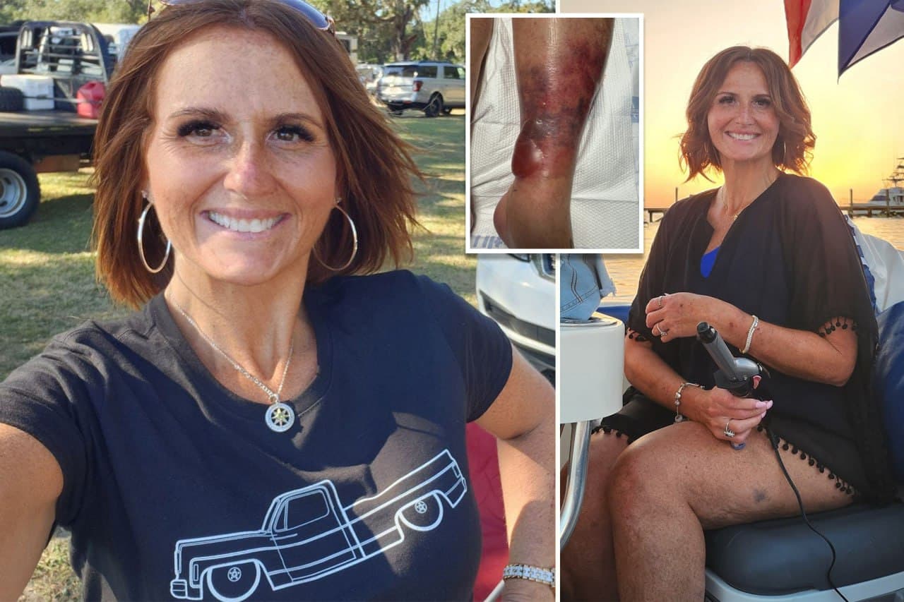 Featured image for: Woman Survives Flesh-Eating Bacteria After Florida Beach Swim Woman Survives Flesh-Eating Bacteria After Florida Beach Swim