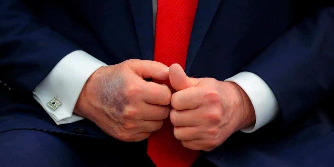 President Trump reports bruised hands from high doses of aspirin