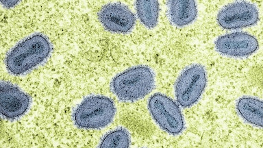 Image for California reports first U.S. cases of potentially severe mpox strain