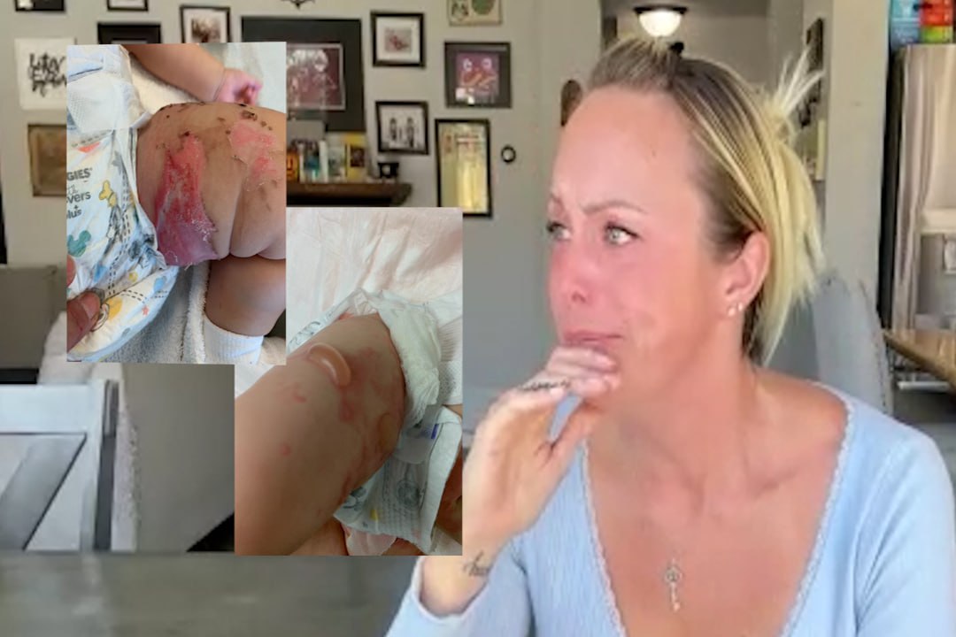 Mother Faces $100K Bill After Emergency Airlift for Burned Baby; Debt Resolved After Media Attention